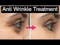 How to improve wrinkles  by botox treatment by dr anil soni genesis