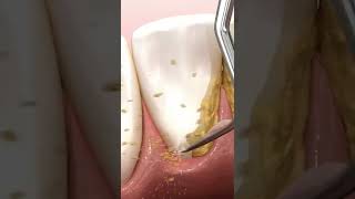 deep teeth cleaning #shorts (scaling and root planing procedure)