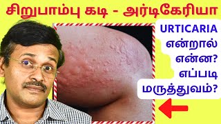 அர்டிகேரியா தோல் அழற்சி மருத்துவம் | urticaria (hives) skin allergy treatment screenshot 3