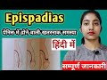 Epispadias in hindiepispadias alka medical classes