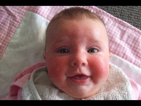 How to treat baby eczema 