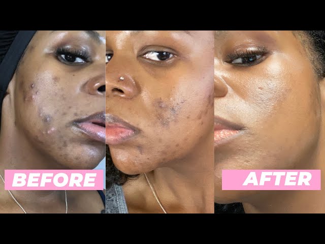 How to get rid of dark spots on black skin