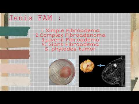 Klasifikasi dan Patofisiologi FAM | Fibroadenona Mamae