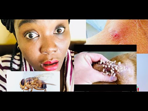 MANGO FLY|| THE FLY THAT GETS UNDER YOUR SKIN|| CUTANEOUS MYASIS|| DR SARU||