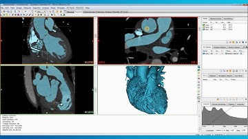 How to Create a Heart Model for 3D Printing |  Mimics Innovation Suite | Materialise Medical
