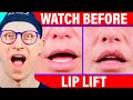 Lip Lift Healing Process