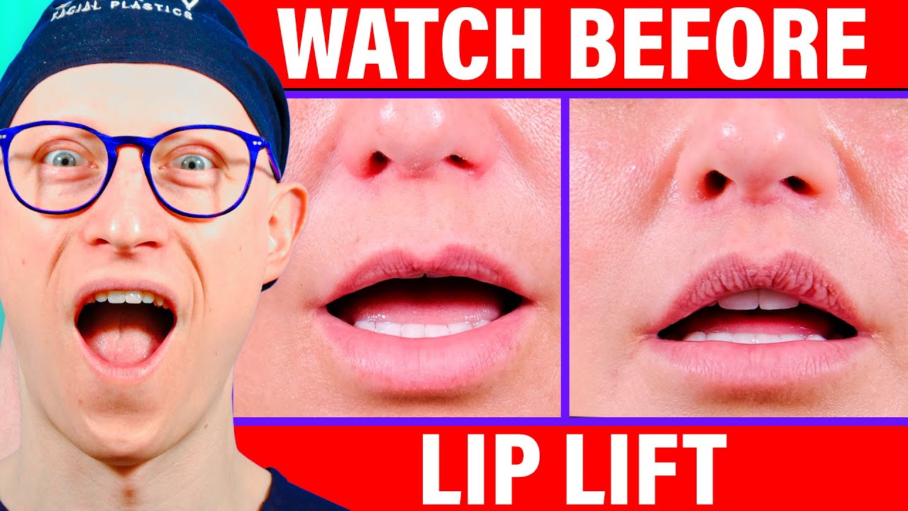 Lip Lift Healing Process