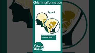 Chiary Malformation | 1 min pathology