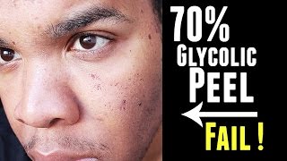 70% Glycolic Peel | First Time FAIL | Session #1