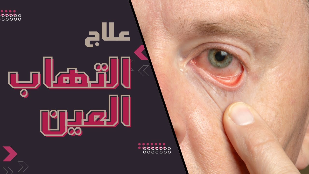 شرح ادوية التهاب العين | Eye | Conjunctivitis