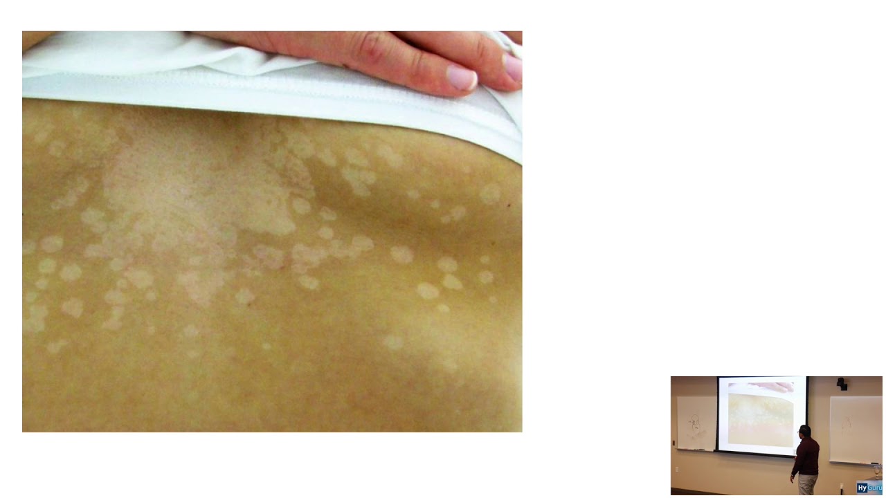 HyGuru USMLE Step 1: Dermatology | Fungal Rashes - YouTube