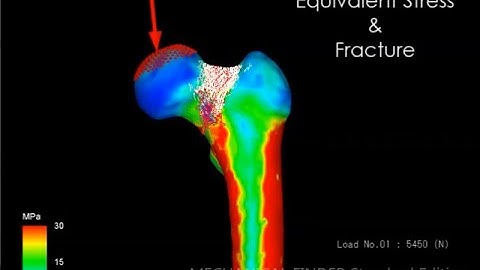 Quantitative CT-based Finite Element Analysis of Femoral Neck Fracture