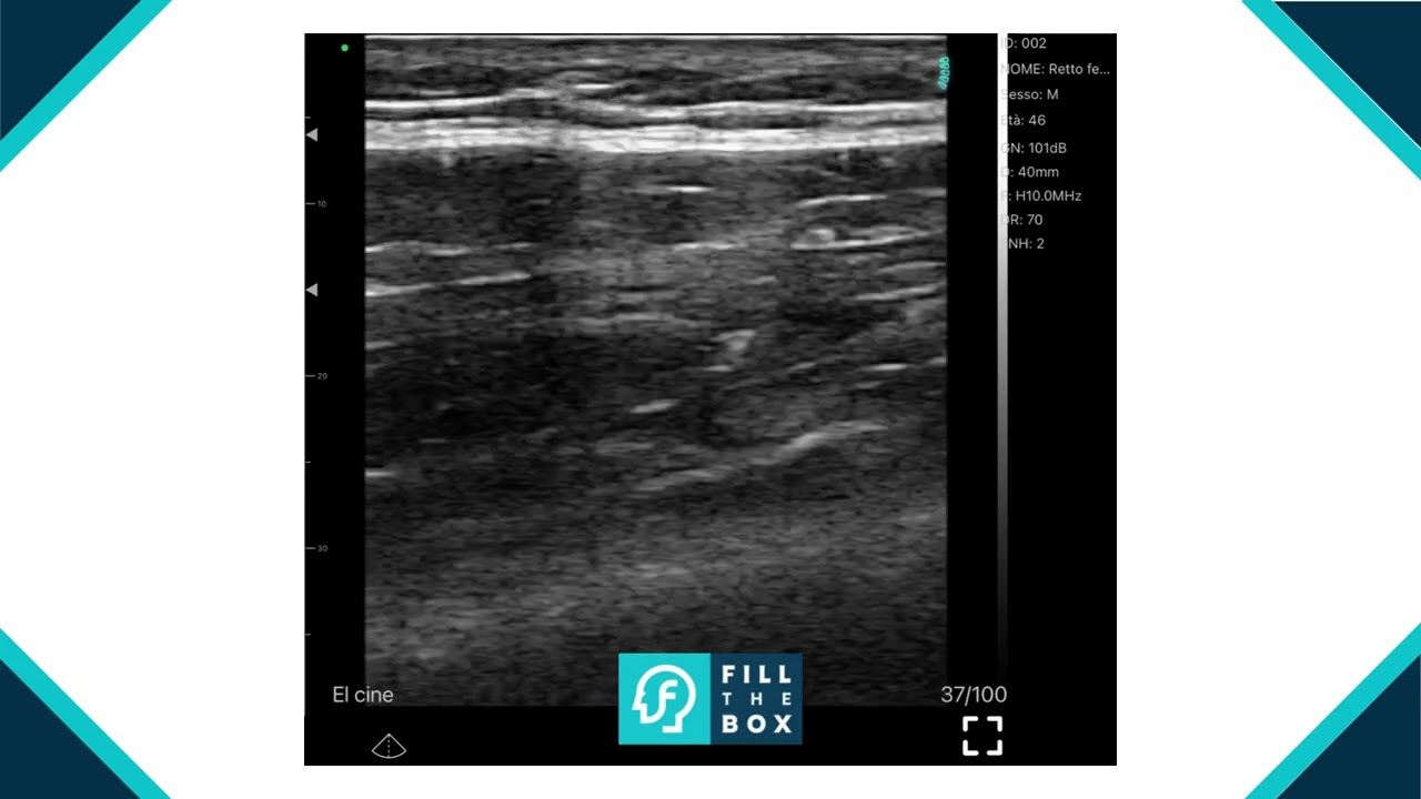 ECOGRAFIA MUSCOLO SCHELETRICA RETTO FEMORALE