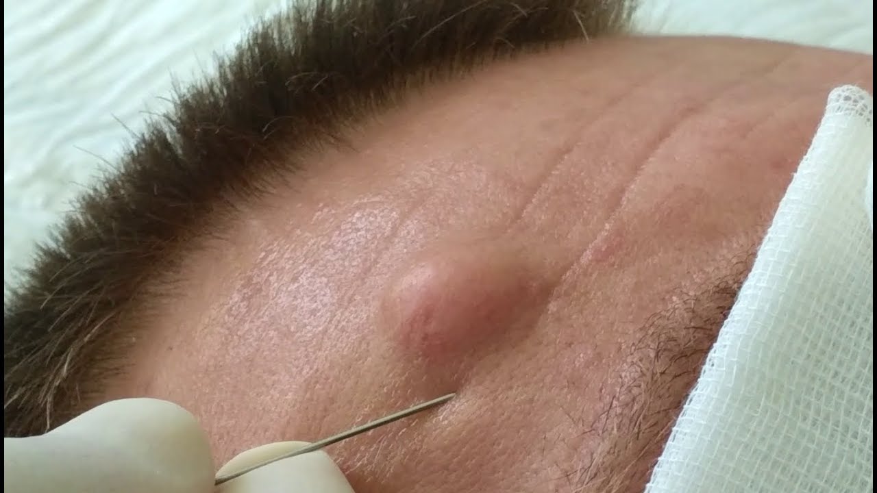 Sebaceous Cyst On FaceАтерома лица Youtube