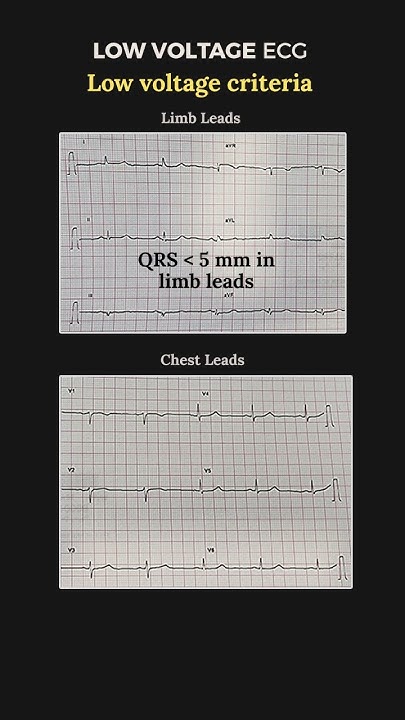 Low Voltage ECG - Criteria & Causes - YouTube