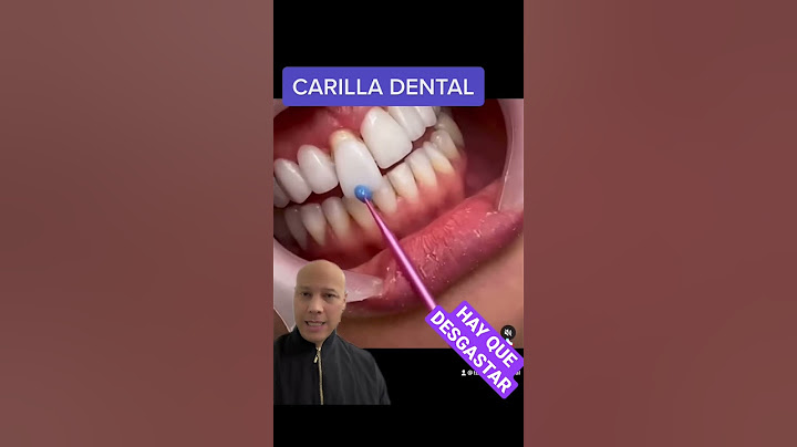 EL PEOR ERROR DE LAS CARILLAS DENTALES