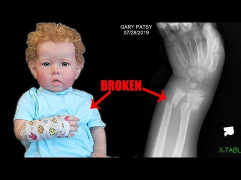 reborn-toddler-gary-goes-to-doctor-for-broken-arm-and-gets-a-real-cast!