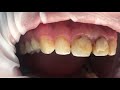 ASMR Dentist 🦷 Teeth Design and Teeth Cleaning l Dentist Cleans Your Teeth!!