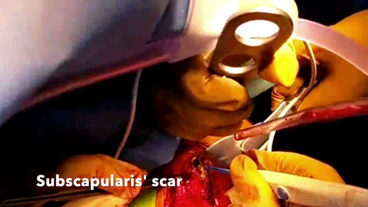 #mixed reality Revision Shoulder Arthroplasty Dr. Taha using #HoloLens2 and Microsoft remote assist