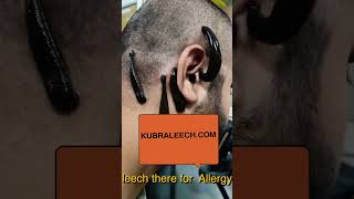 Leech Therapy for Allergies: Natural Detox & Immune Support