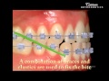 Correcting an Underbite at Centertown Orthodontics