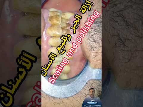 تلميع الأسنان       دكتور عبدالله سلطان الهنداوي طبيب اسنان