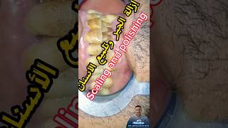 تلميع الأسنان ||polishing teeth dr_abdullah_sultan_dentist دكتور_عبدالله_سلطان_الهنداوي_طبيب_اسنان