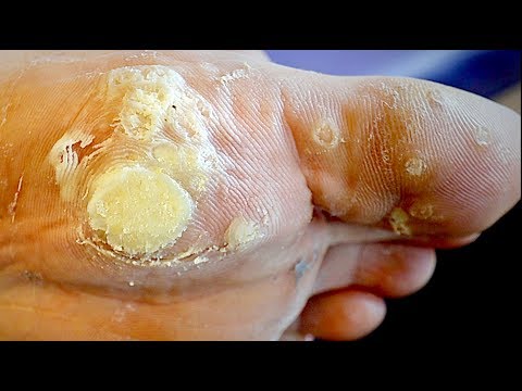 MASSIVE DEAD WART REMOVAL (this kid&rsquo;s a stud) | Dr. Paul