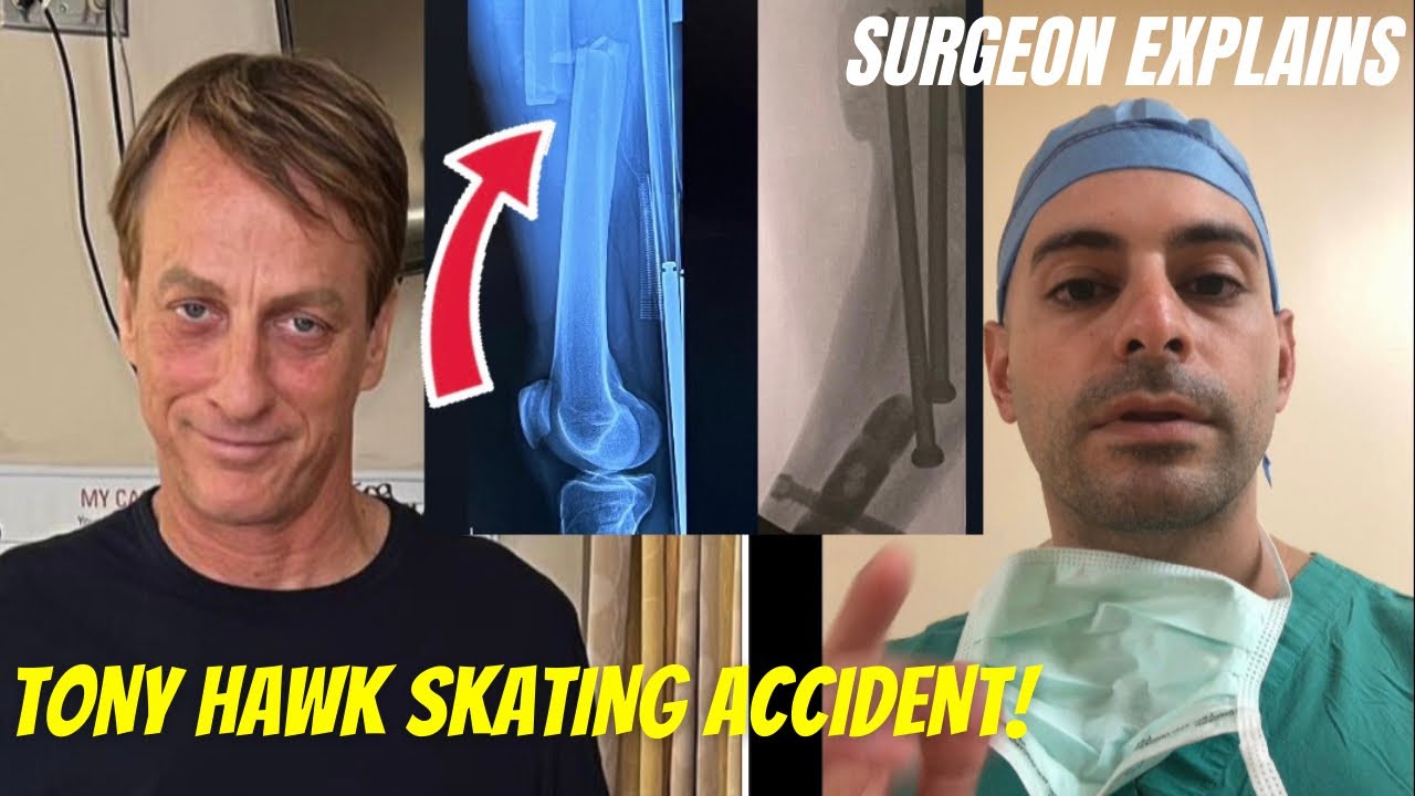 Tony Hawk breaks his leg