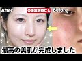 【インナードライ改善スキンケア】毛穴・乾燥が酷かった私が超絶美肌になった最強ルーティン