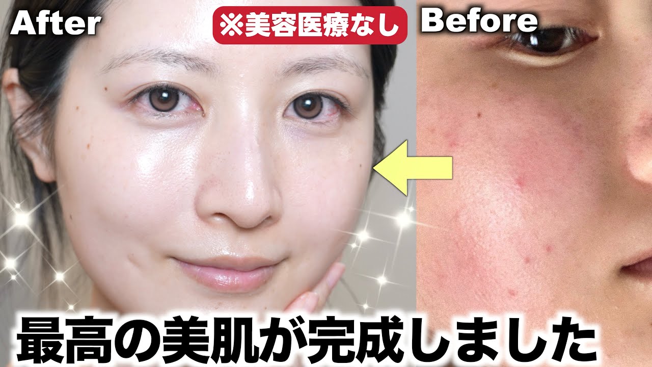 【スキンケア】毛穴・乾燥が酷かった私が超絶美肌になった最強ルーティン【インナードライ改善】