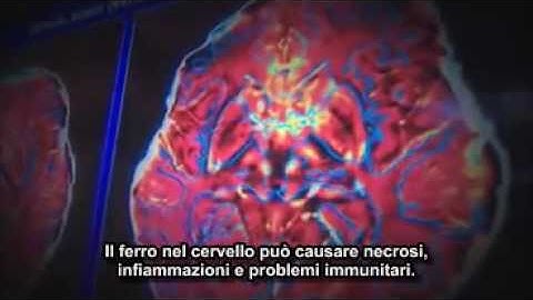 Servizio Ctv W 5 (Canada) - parte 1 - CCSVI nella Sclerosi Multipla - 2009-11-21