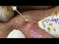 Treatment of blackheads and whiteheads (394) | Loan Nguyen