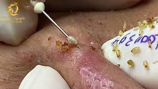 Treatment of blackheads and whiteheads (394) | Loan Nguyen