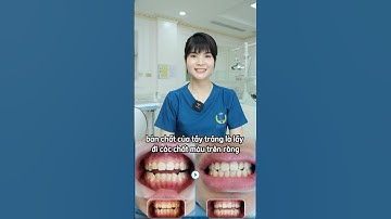 Ai đang muốn tẩy trắng răng thì nhất định phải biết điều này! || Nha Khoa Quốc Tế Việt Đức