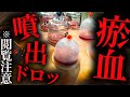 【閲覧注意　瘀血噴出】吸い玉で瘀血がドクドク出る鍼灸治療　首肩甲骨がヤバすぎ吸い玉と鍼で改善　吸い玉からドクドクヤバい瘀血がでた　自宅でできる方法もお伝えします　【鍼灸治療　銀座・横浜元町】