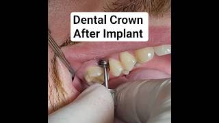 Doctor removes healing screw of dental implant | Before and After