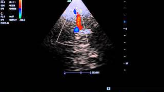 transcranial doppler in patient with hyperdynamic circulation due to anemia