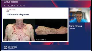 Bullous diseases 2