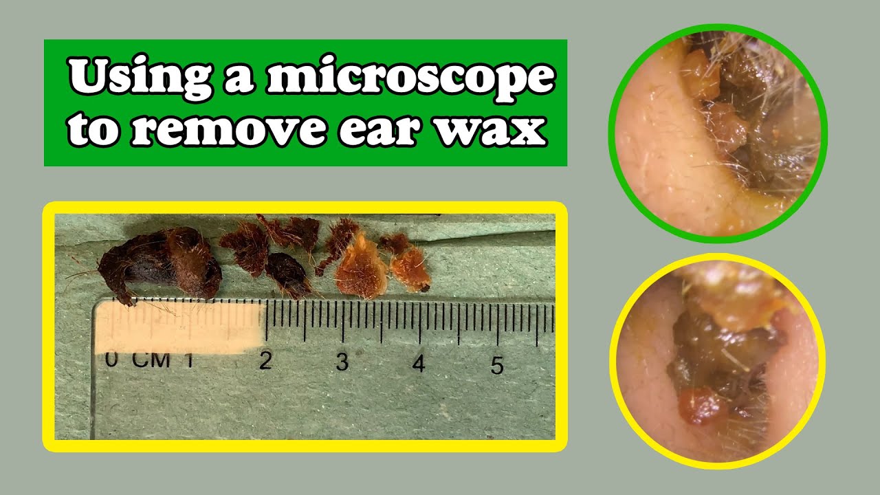 Ear Wax Removal (EP45) YouTube