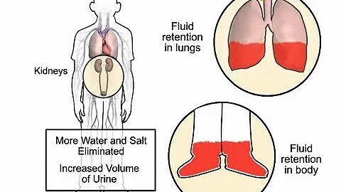 How diuretics work in heart failure