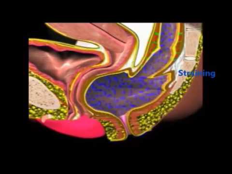 hernia treatment in homeopathy in hindi Healing Hands Clinic -Lucky STARR