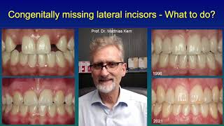 Congenitally missing lateral incisors - What to do?
