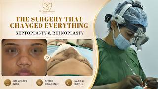 Natural Rhinoplasty Before & After | Beautiful Nose Surgery Transformation | Dr. Monisha Kapoor