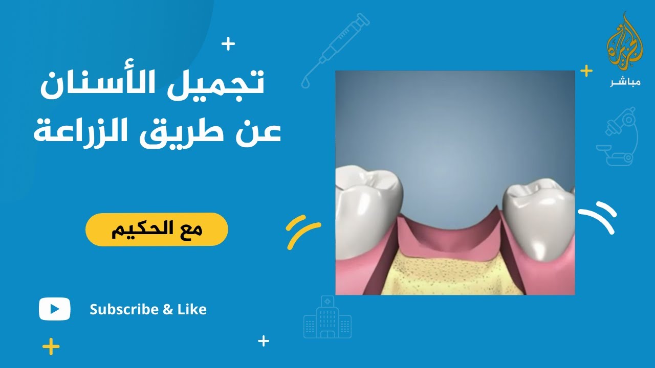 متى تكون زراعة الأسنان كافية دون الحاجة لإجراءات تجميل أخرى؟