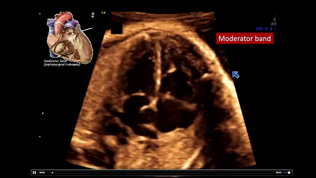 2022 Fetal Echocardiography Normal and Abnormal Hearts A Video CME