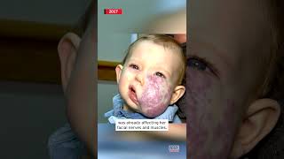 Little Girl Got Surgery To Remove Facial Tumor #Shorts