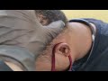 Alopesia Areta Ganje Sir per Baal Aagaye Hai. 8867239831
