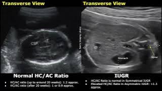 Obstetric Ultrasound Normal Vs Intrauterine Growth Restriction (IUGR) | Placental Insufficiency USG