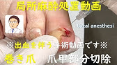 巻き爪矯正 最新の治療 自分で 簡単に 手術せずに痛みからの解放 ネイル エイド 大学病院採用 一般医療機器 巻き爪矯正 Ingrown Toenail Correction Device Youtube 巻き爪矯正 最新の治療 自分で 簡単に 手術せずに痛みからの解放 ネイル エイド 大学病院採用 一般医療機器 巻き爪矯正 Ingrown Toenail Correction Device Youtube